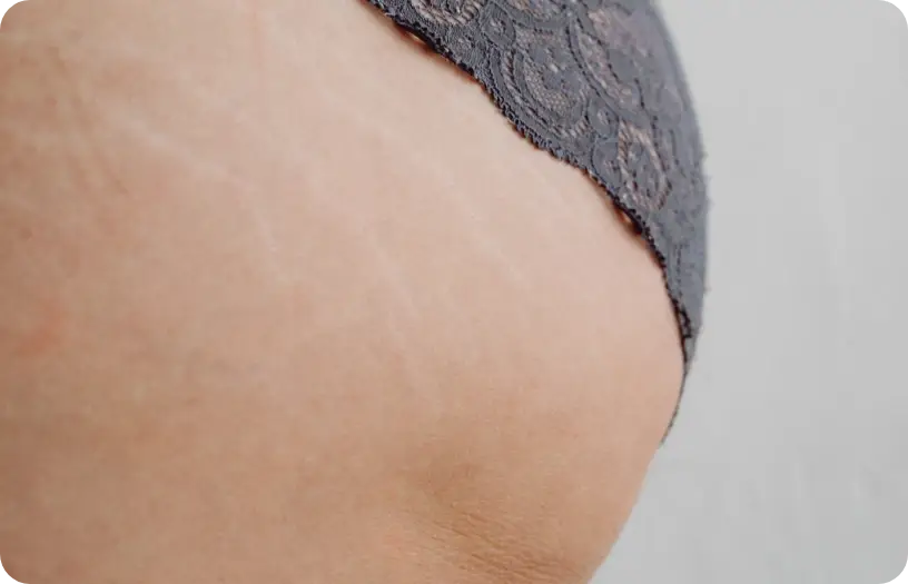 Tratamiento de micropuntura para eliminación de estrías en clínica estética en Hermosillo